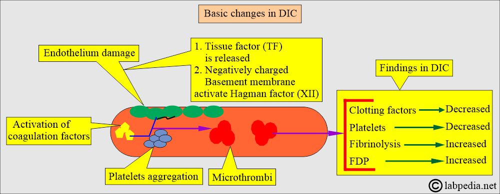 DIC pathogenesis DIC pathogenesis