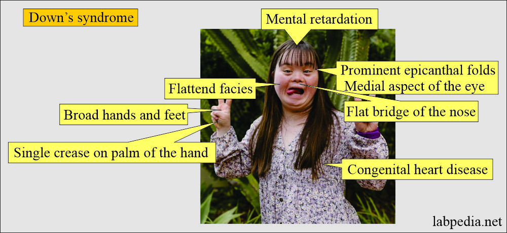 Down's syndrome clinical presentation