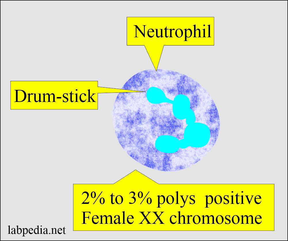 Drum-stick in Neutrophil