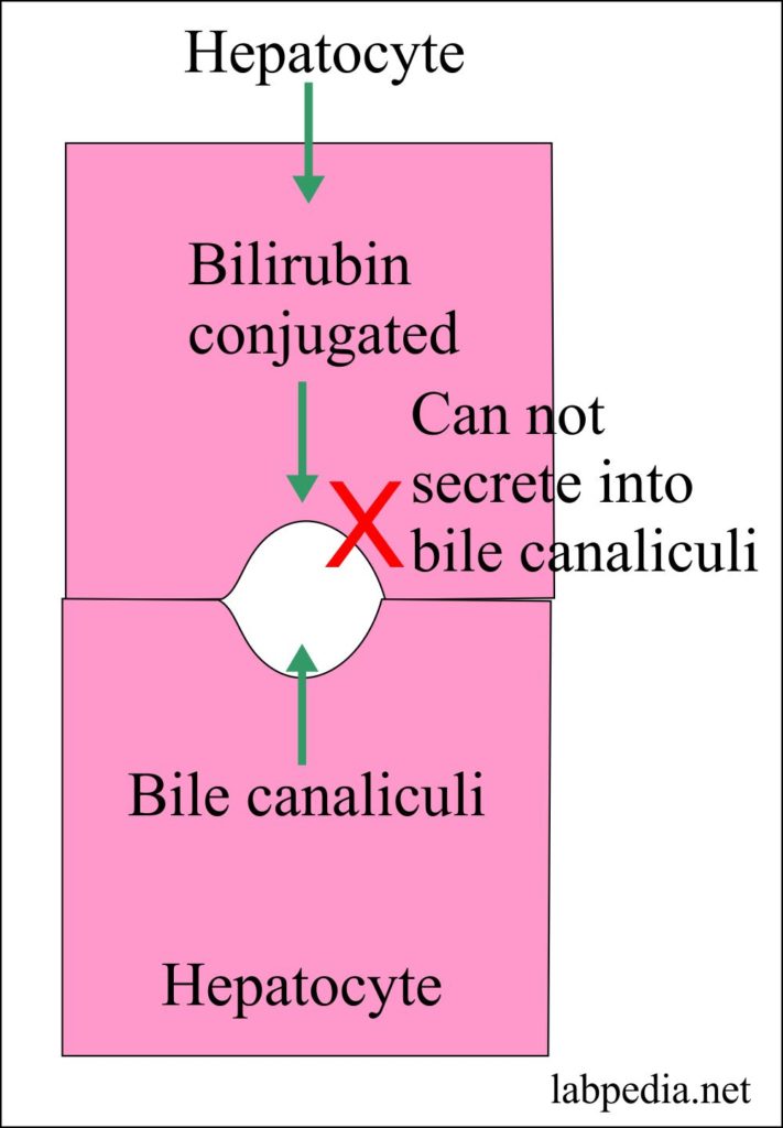DubinJohnson Syndrome Diagnosis