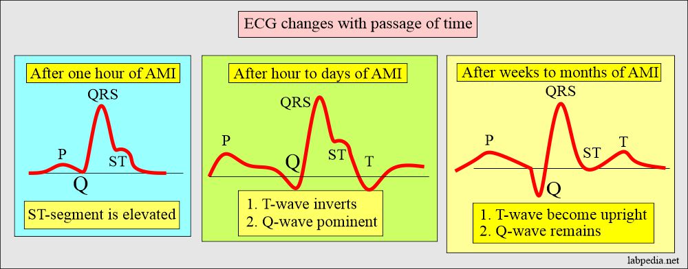 ECG changes with passage of time