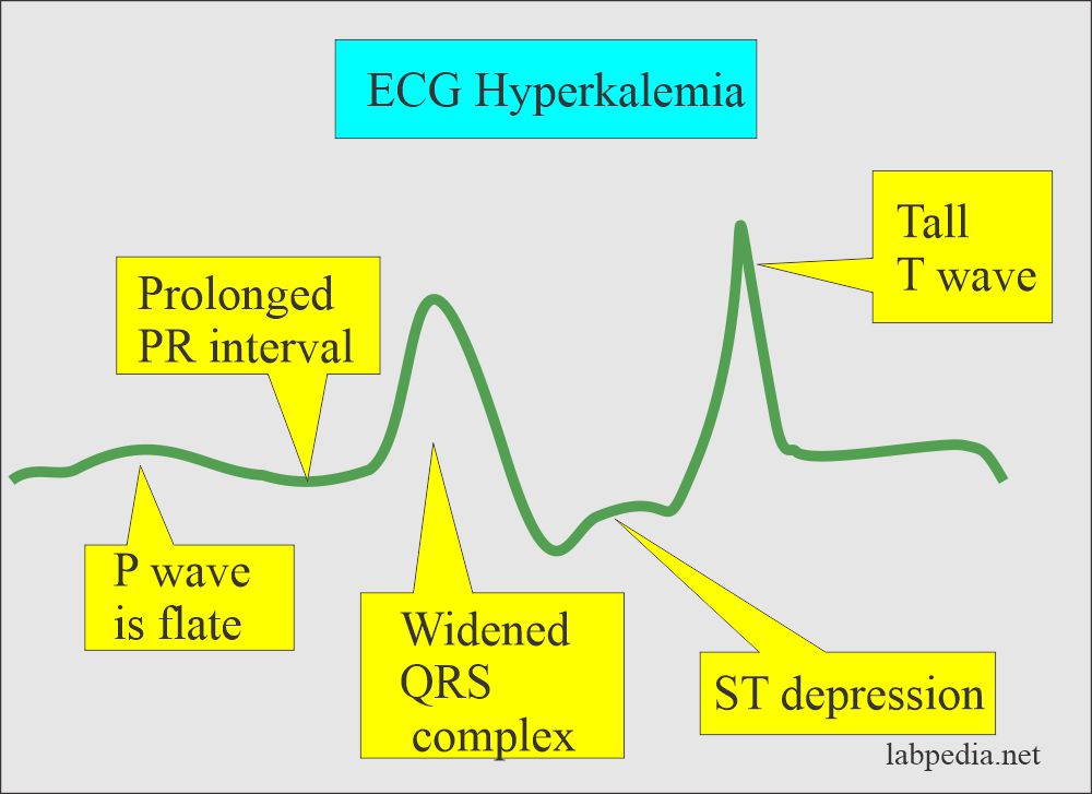 ECG changes in Hyperkalemia