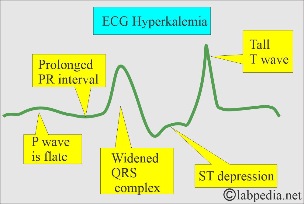 ECG changes in Hyperkalemia ECG changes in Hyperkalemia