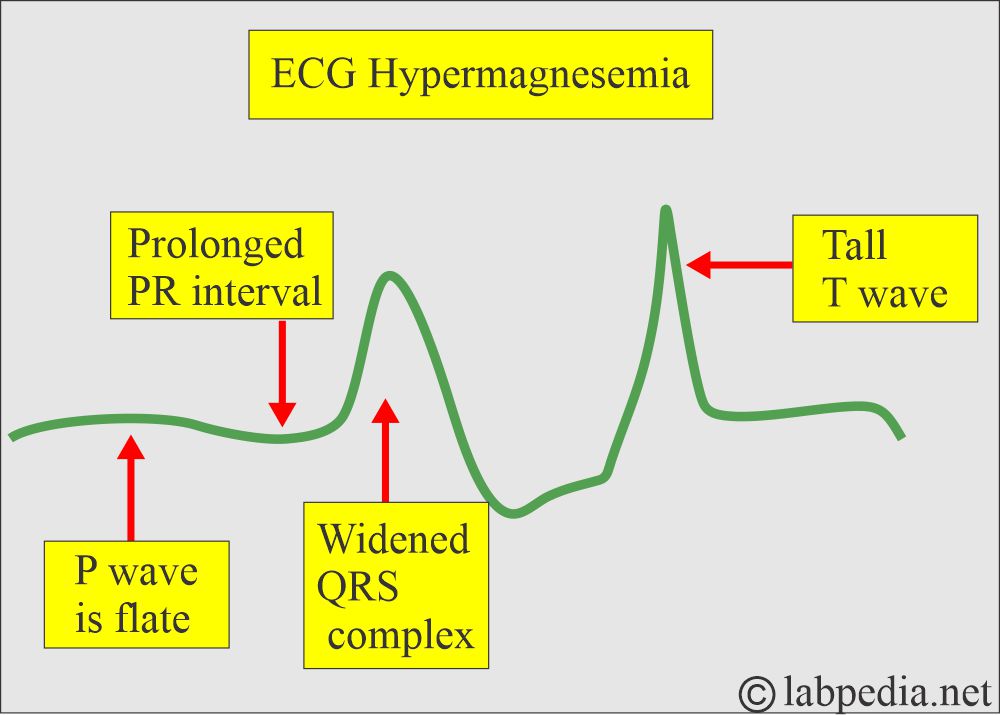 ECG in Hypermagnesemia