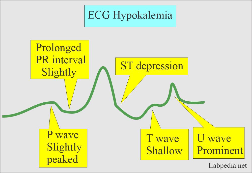 ECG Hypokalemia