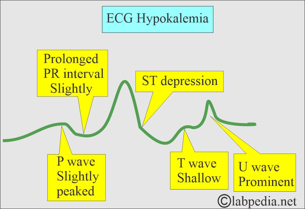 ECG changes in Hypokalemia ECG changes in Hypokalemia