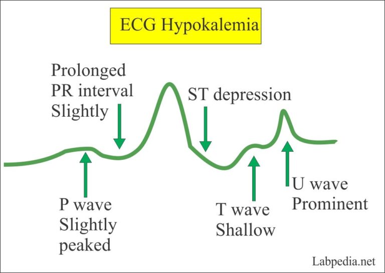 Electrolytes – Part 4 – Sodium and Potassium (Na+ and K+), ECG changes ...