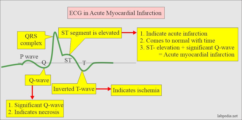 ECG, simple representation in acute myocardial infarction