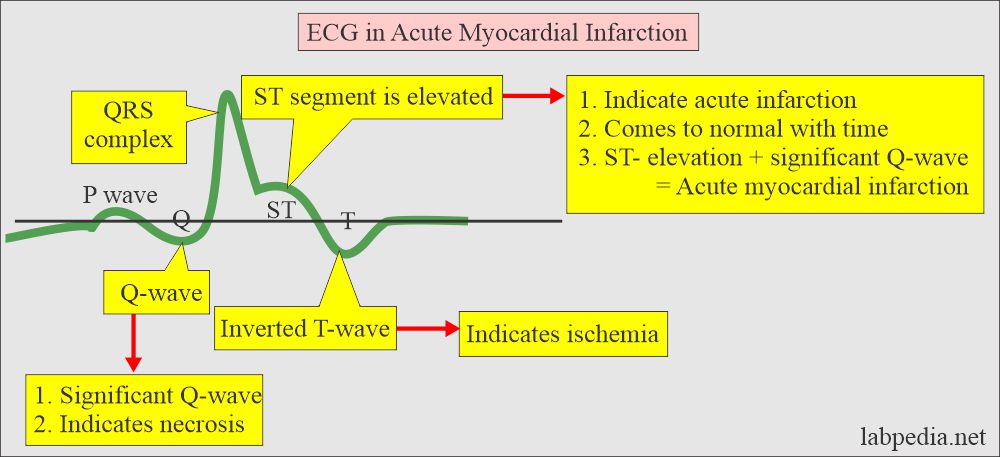 ECG changes in acute myocardial infarction (AMI)