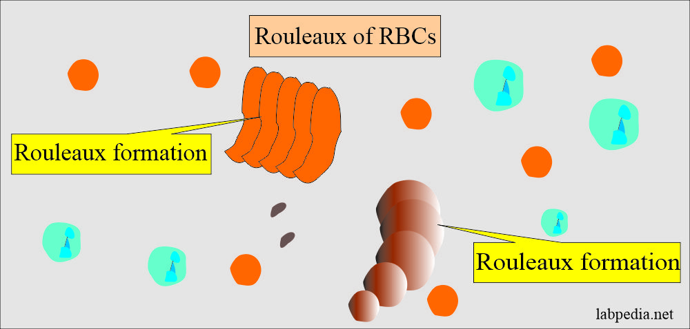 Erythrocyte Sedimentation Rate (ESR): Rouleaux formation affecting ESR