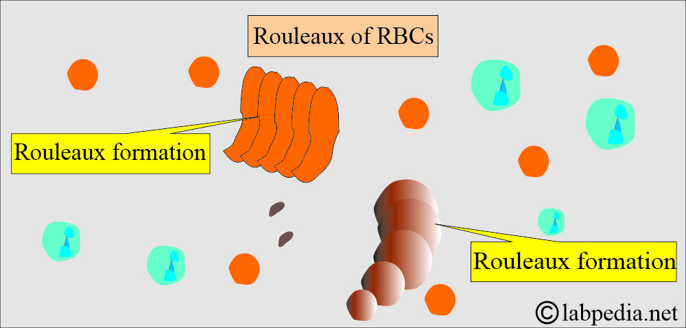 ESR and rouleau formation ESR and rouleau formation