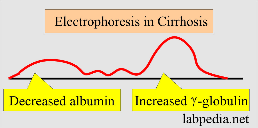 Electrophoresis cirrhosis