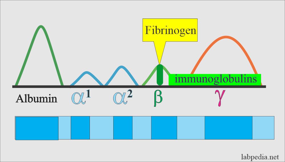 Electrophoresis showing band of fibrinogen