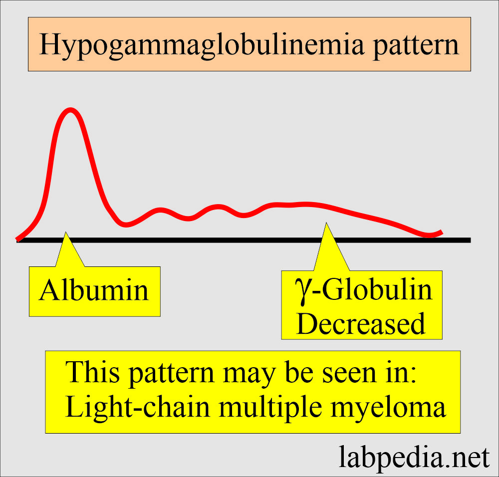 Electrophoresis hypogammaglobulinemia pattern