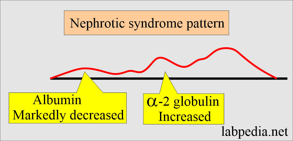 Electrophoresis nephrotic syndrome
