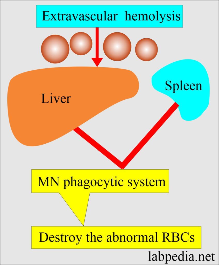 Anemia:- Part 8 - Hemolytic Anemias Classification, Lab Diagnosis ...