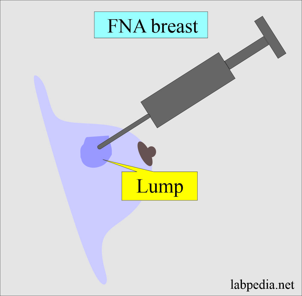 Fine needle aspiration Cytology (FNAC): FNA breast procedure 