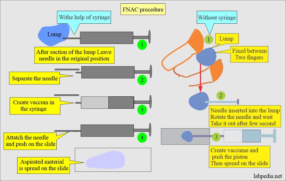 Fine needle aspiration Cytology (FNAC): FNA procedures