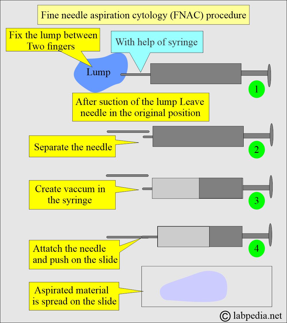 Fine needle aspiration Cytology (FNAC): FNA procedure Fine needle aspiration Cytology (FNAC): FNA procedure