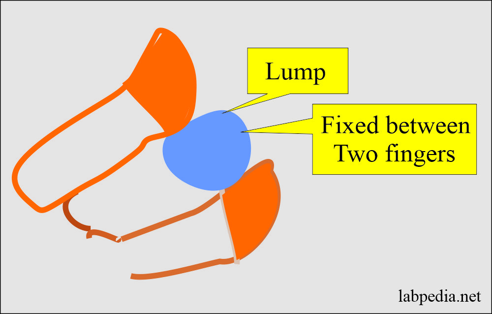 FNA procedure to fix lump