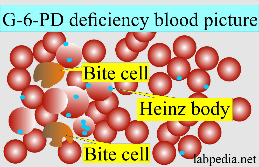 Glucose-6-phosphate dehydrogenase (G6PD) deficiency blood picture