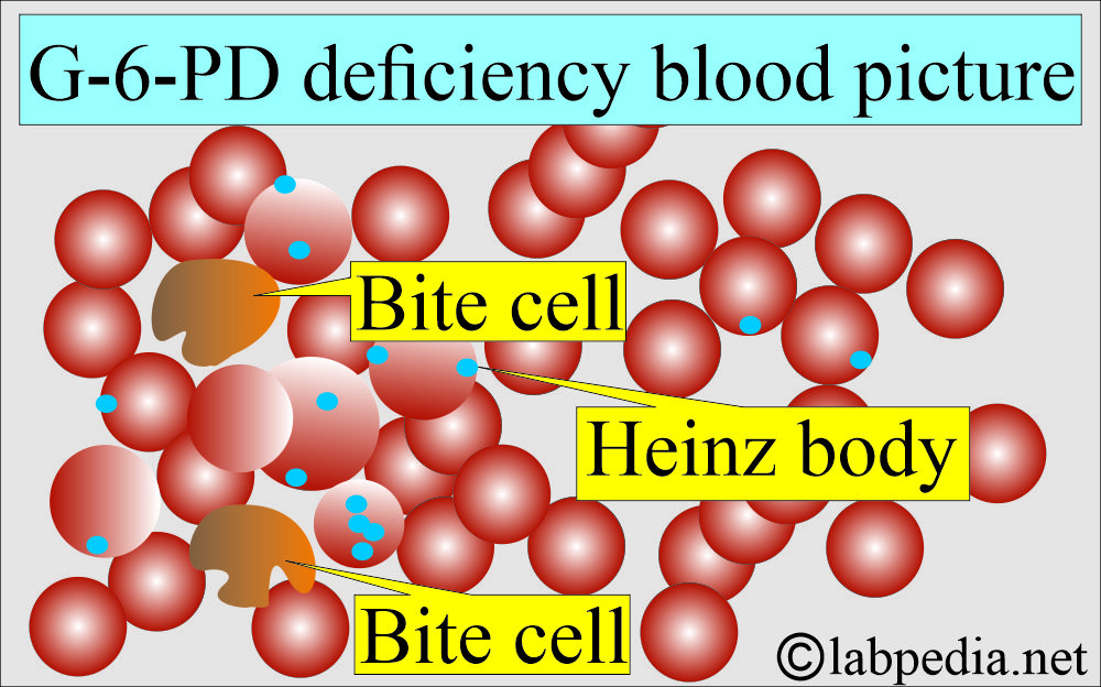 G6PD blood picture G6PD blood picture