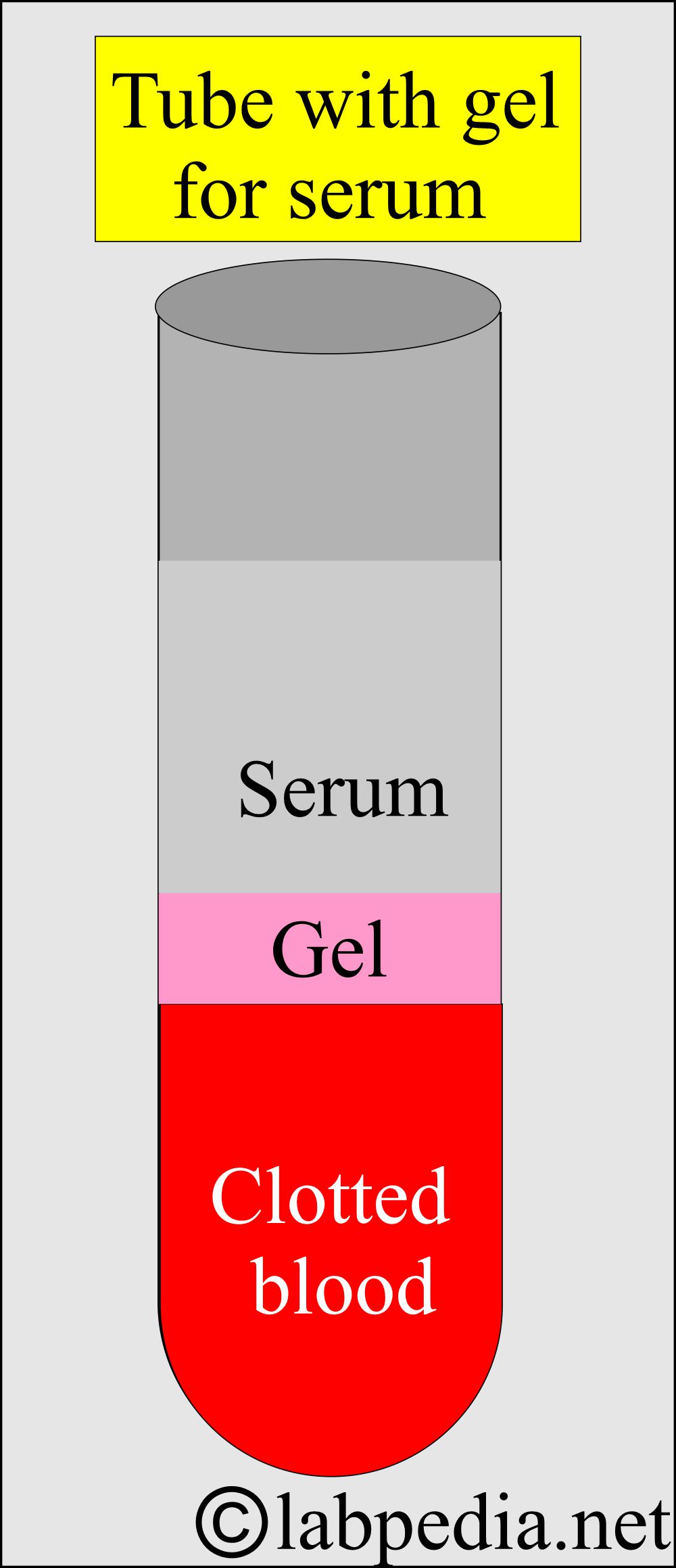 Serum separated in Gel tube Serum separated in Gel tube