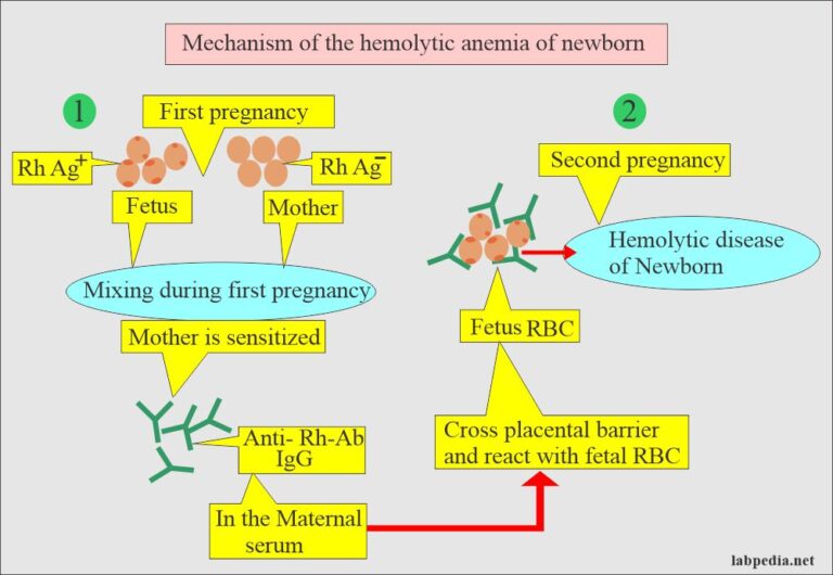 Hemolytic Anemia Of Newborn Hdn And Coombs Test