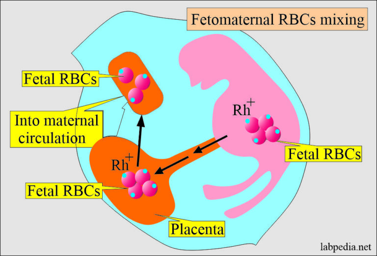 hemolytic-anemia-of-newborn-hdn-and-coombs-test