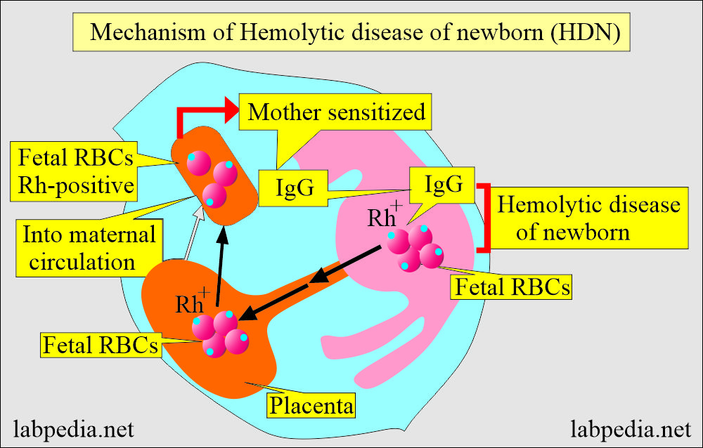 Mechanism of hemolytic disease of newborn (HDN)