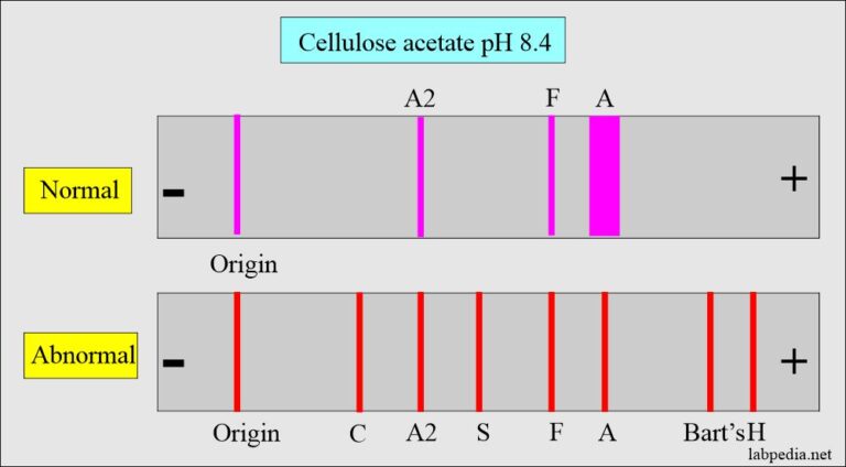 Hemoglobin Part 2 Hemoglobin Electrophoresis Hb Electrophoresis   Hb Electrophoresis Acetate Cdr 1 768x424 