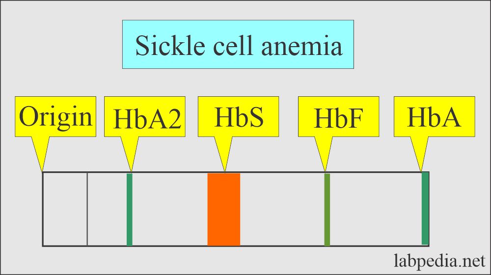 Sickle cell anemia electrophoresis