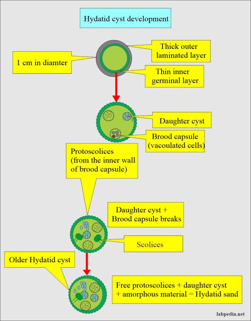 Echinococcus Granulosus Hydatid Cyst And Hydatid Disease