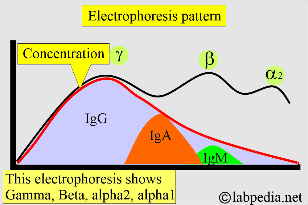 Immunoglobulin electrophoresis pattern Immunoglobulin electrophoresis pattern
