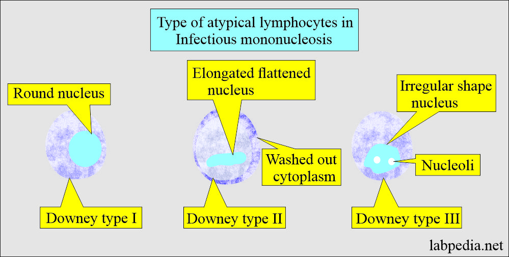 Epstein-Barr virus (EBV): Atypical lymphocytes in Infectious mononucleosis