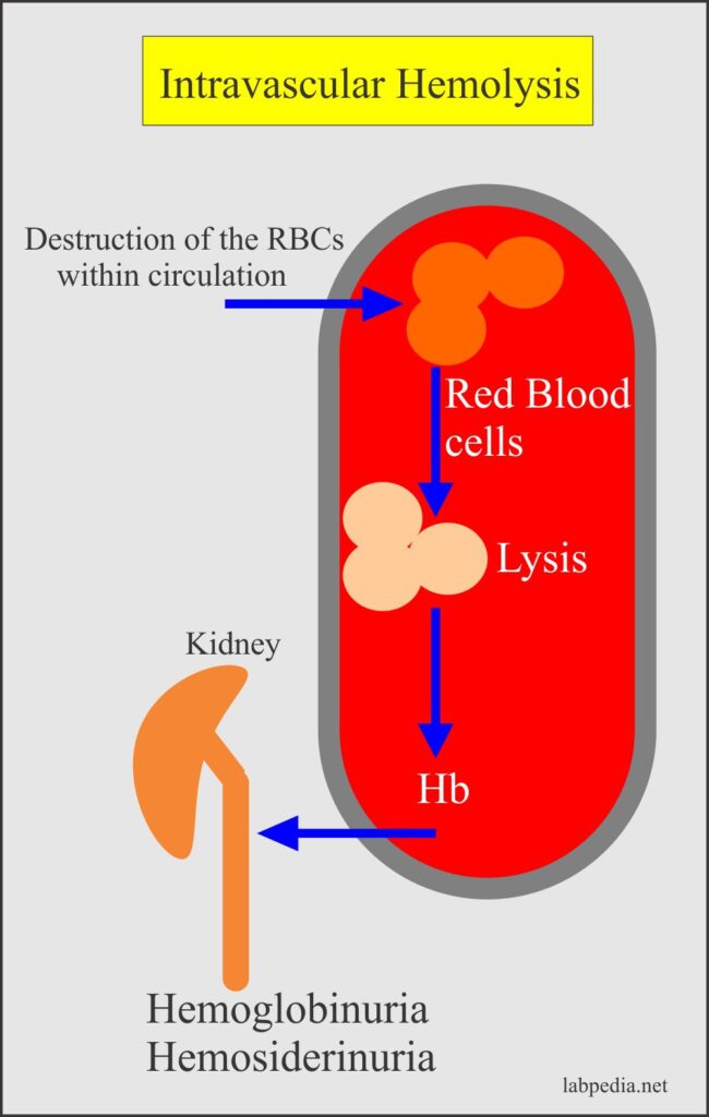 Anemia Part Hemolytic Anemias Classification Autoimmune Hemolytic Anemia Causes And Lab