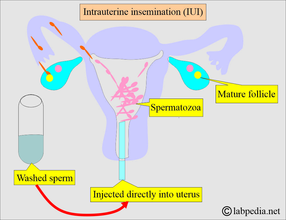 Intrauterine insemination procedure