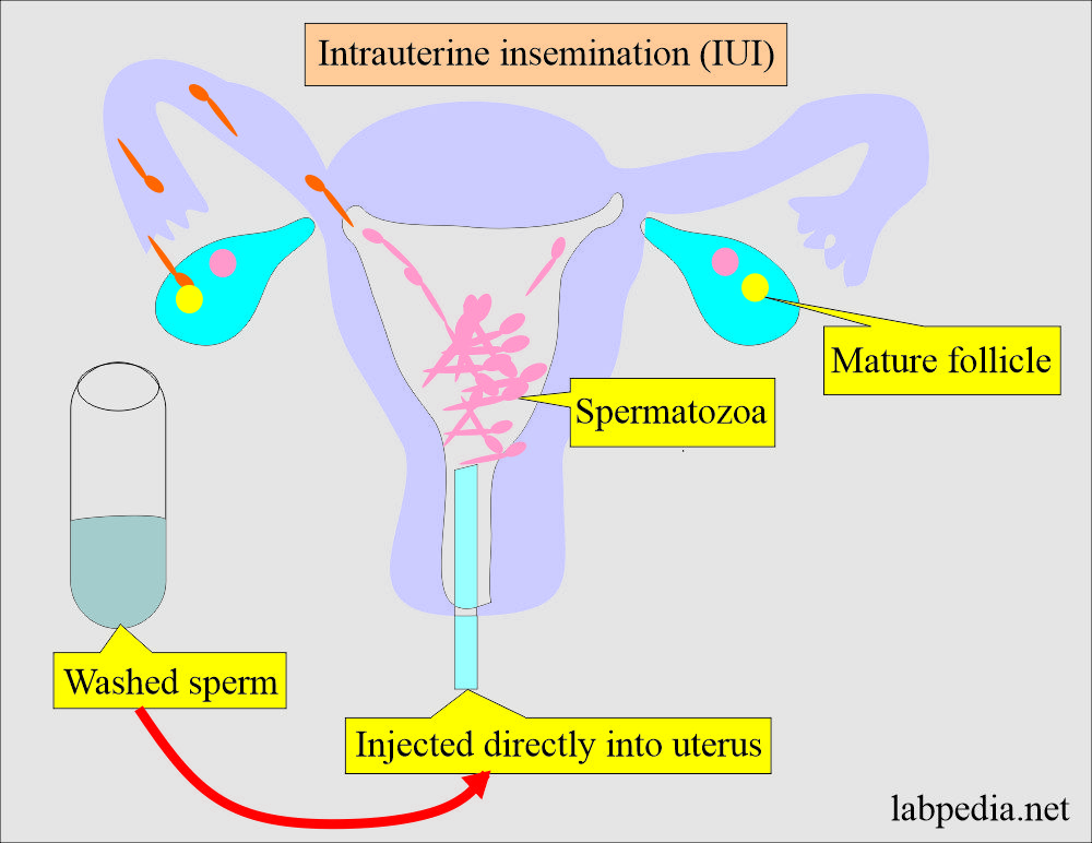 Intrauterine insemination, IUI (Semen Preparation)