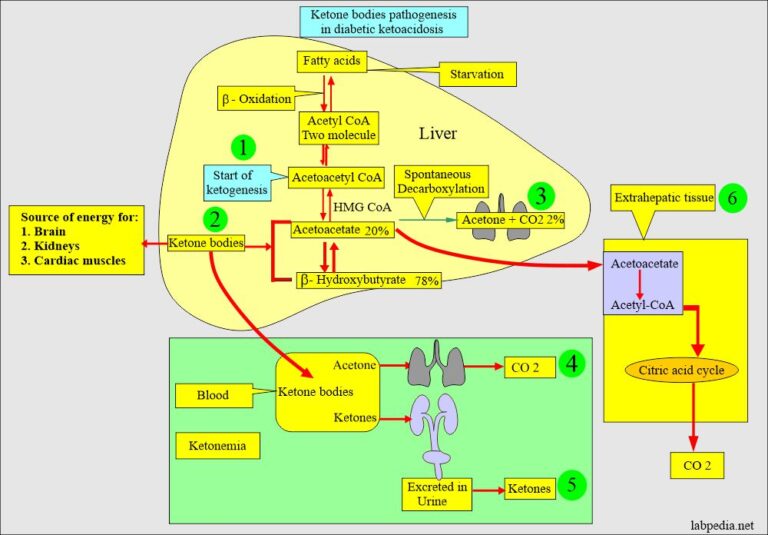 Ketoacidosis diagnosis, Diabetic Ketoacidosis - Labpedia.net