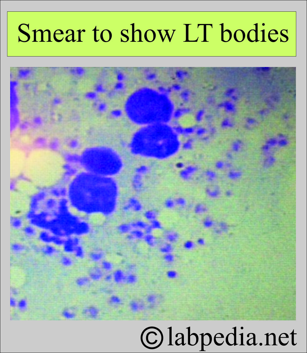 LT bodies seen in the smear