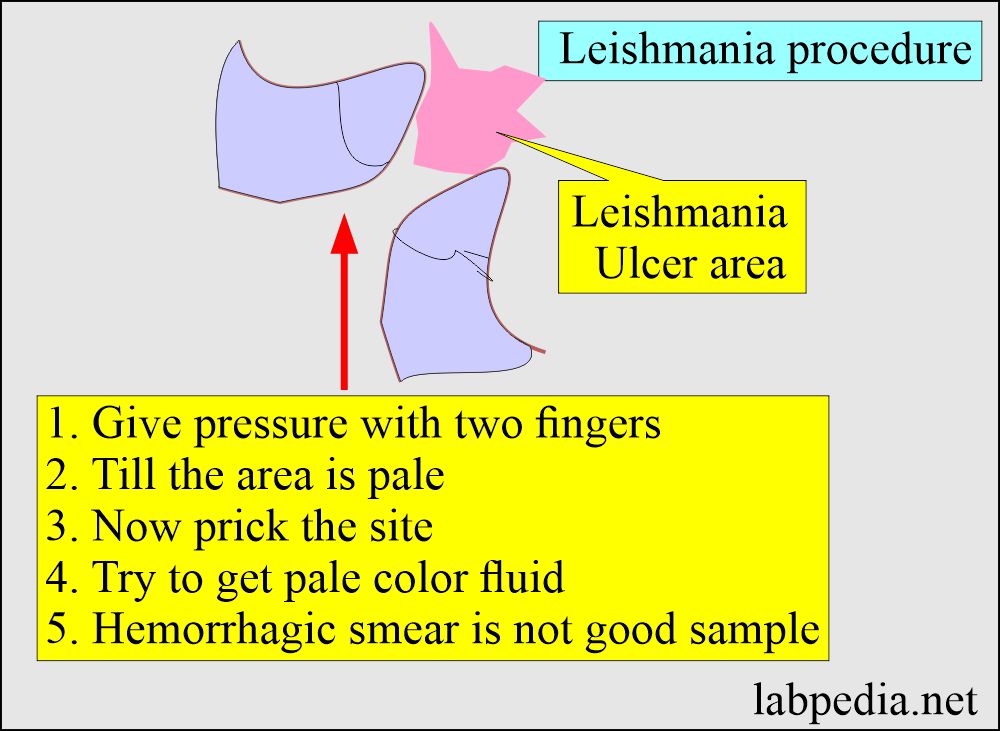 LT smear procedure
