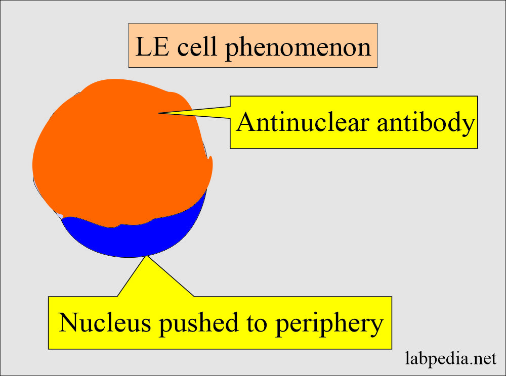 Le cell phenomenon: Nucleus is pushed to periphery