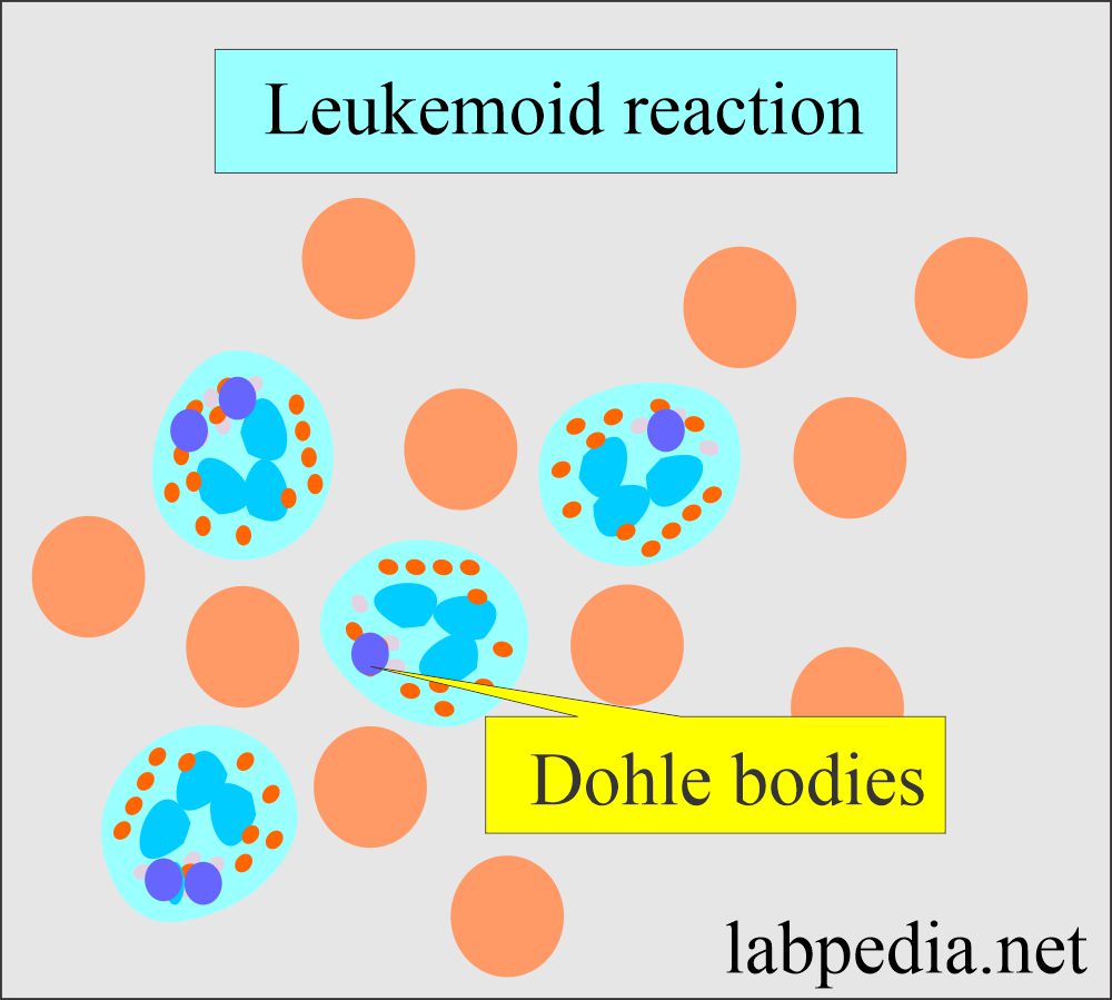 Leukemoid reaction Dohle bodies