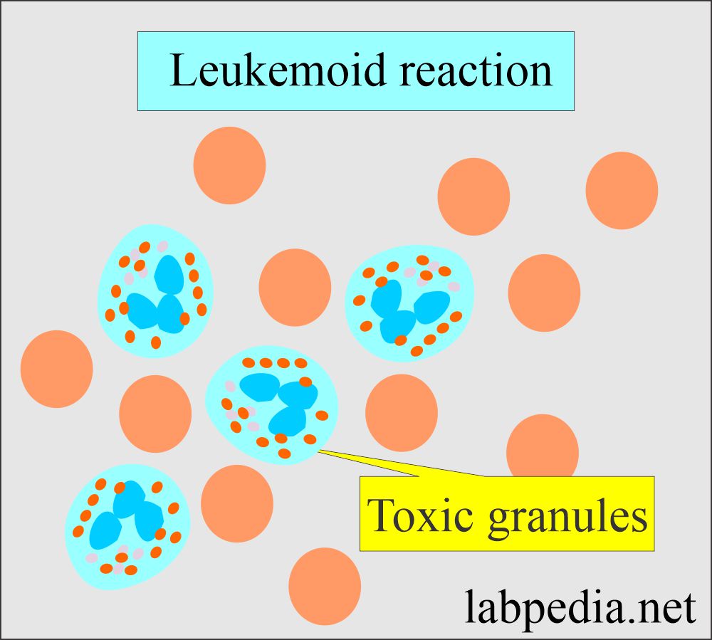 Leukemoid reaction, toxic granules