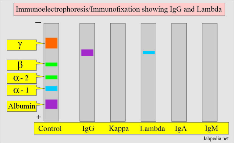 Bence Jones Proteinuria Bj Proteinuria And Multiple Myeloma 8383