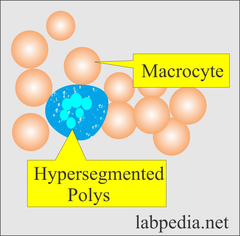 Mean corpuscular volume (MCV): Macrocytic RBCs and hypersegmented polys.