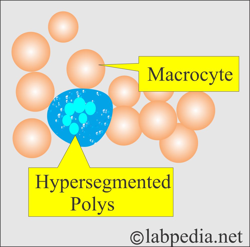 Macrocytosis seen in megaloblastic anemia Macrocytosis seen in megaloblastic anemia