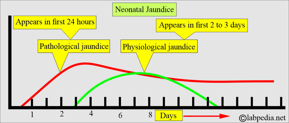 Neonatal jaundice classification Neonatal jaundice classification