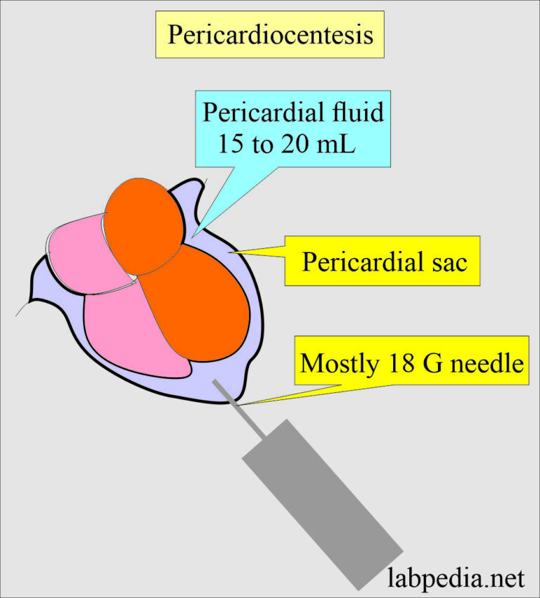 Fluid Analysis:- Part 7 - Pericardial Fluid Analysis, Pericardiocentesis