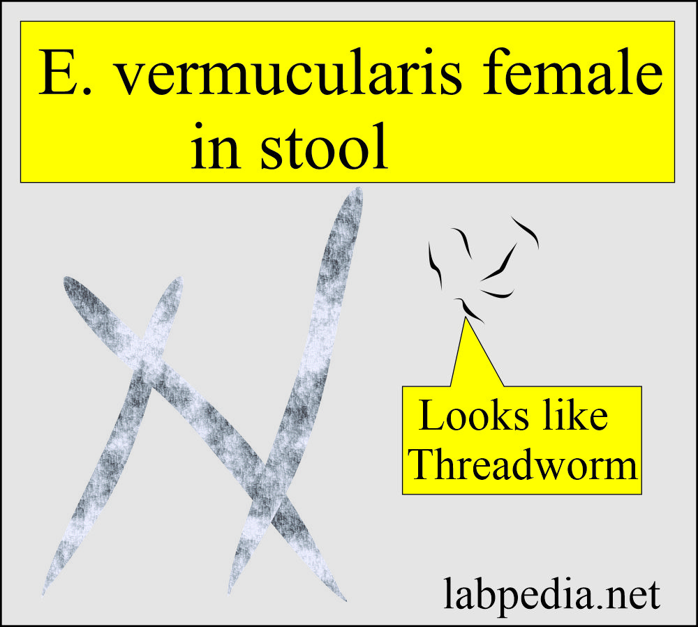 E. vermicularis (Pinworm) females in stool
